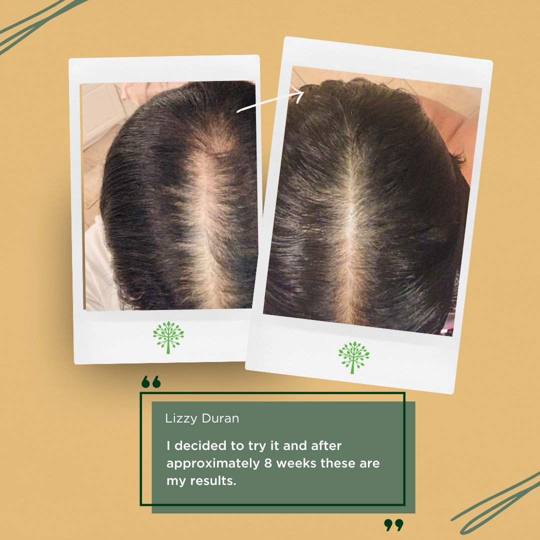 purityproducts's tweet photo. Lizzy's hair journey has been amazing! Check out these before and after results from using MyBiotin™ ProClinical. 🤩 This new, patented form of Biotin is guaranteed to promote thicker hair, so you can achieve the luscious locks of your dreams. #PurityProducts https://t.co/gSId7hddKH
