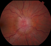 Mayo Clinic Department of Ophthalmology (@mayocliniceye) on Twitter photo In a recent <a href="/MayoClinicEye/">Mayo Clinic Department of Ophthalmology</a> #GrandRounds, <a href="/VSwaminathanMD/">Vishal Swaminathan</a> educates on criteria to clinically diagnose idiopathic intracranial hypertension and various treatment options. #Neuroophthalmology #papilledema
Watch and claim CME: mayocl.in/3Z4hltb In a recent <a href="/MayoClinicEye/">Mayo Clinic Department of Ophthalmology</a> #GrandRounds, <a href="/VSwaminathanMD/">Vishal Swaminathan</a> educates on criteria to clinically diagnose idiopathic intracranial hypertension and various treatment options. #Neuroophthalmology #papilledema
Watch and claim CME: mayocl.in/3Z4hltb