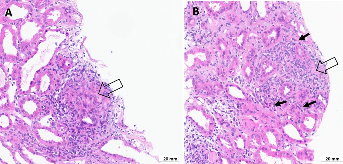 MayoClinicNeph's tweet photo. Immune Checkpoint Inhibitor–Associated Sarcoidosis Reaction in the Kidney: A Case Report @mariacharkviani @HerrmannMd @KidneyMed #MayoClinicNeph https://t.co/8lDiUQotyq https://t.co/rpStKVE8MB
