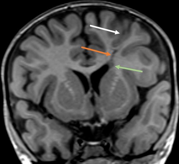 drmankad's tweet image. Tip of the day 💡: Vasculogenesis and Corticogenesis follow each other. Here, a developmental venous anomaly (orange) connecting nodular grey matter heterotopia (green) with a dysgyric cortex (white). Follow the DVA trail.