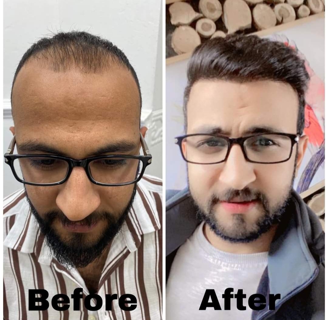 EstethicaP's tweet photo. تَفوق مَركز العالمي في مَجال زراعة الشعر نتيجة لعدة عوامل مُهمة لعلها تُحدد اهم سُبل الحصول على النتائج المثالية ..
📞  https://t.co/aQtEGBHEgS
#الدولي_لزراعة_الشعر
#زراعة_احترافية
#قلم_السفير
#كادر_تركي_متخصص

لمركز العالمي لزراعة الشعر https://t.co/ECIdqsTZp6