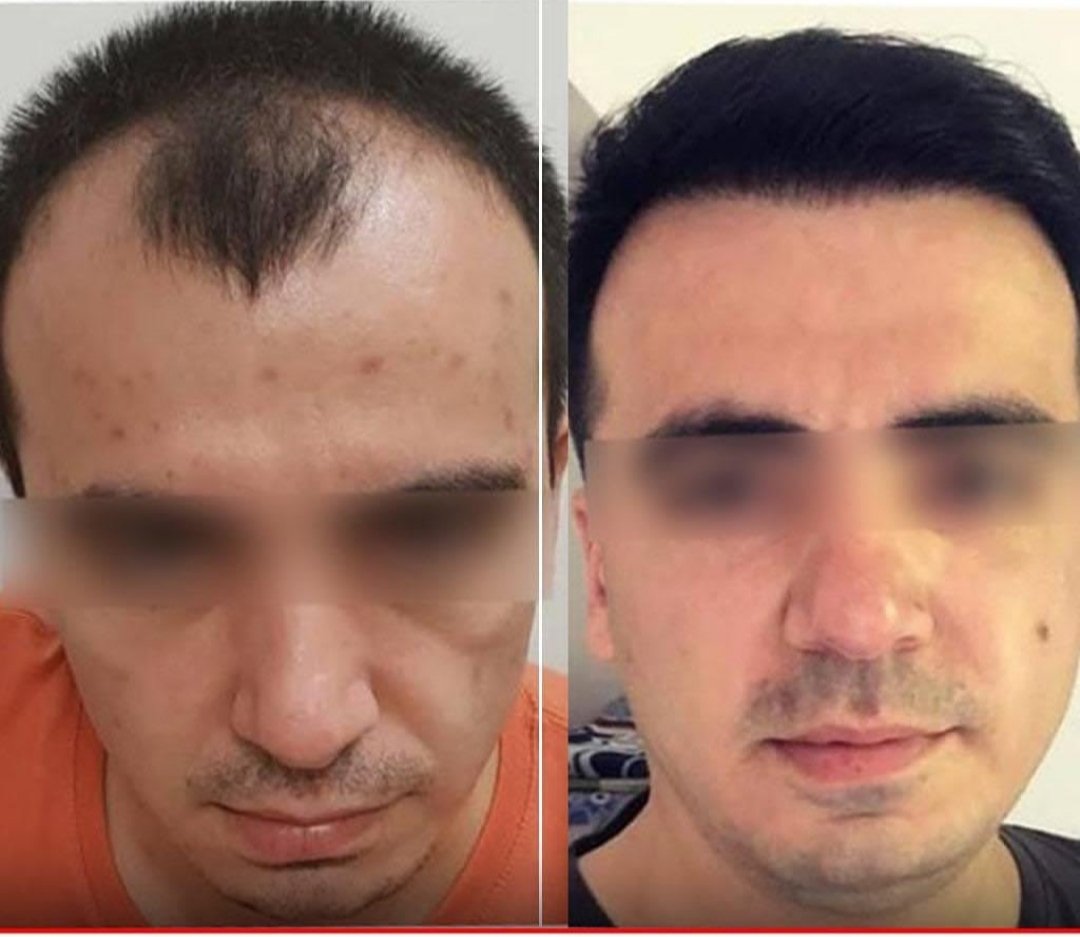 EstethicaP's tweet photo. تَفوق مَركز العالمي في مَجال زراعة الشعر نتيجة لعدة عوامل مُهمة لعلها تُحدد اهم سُبل الحصول على النتائج المثالية ..
📞  https://t.co/aQtEGBHEgS
#الدولي_لزراعة_الشعر
#زراعة_احترافية
#قلم_السفير
#كادر_تركي_متخصص

لمركز العالمي لزراعة الشعر https://t.co/ECIdqsTZp6