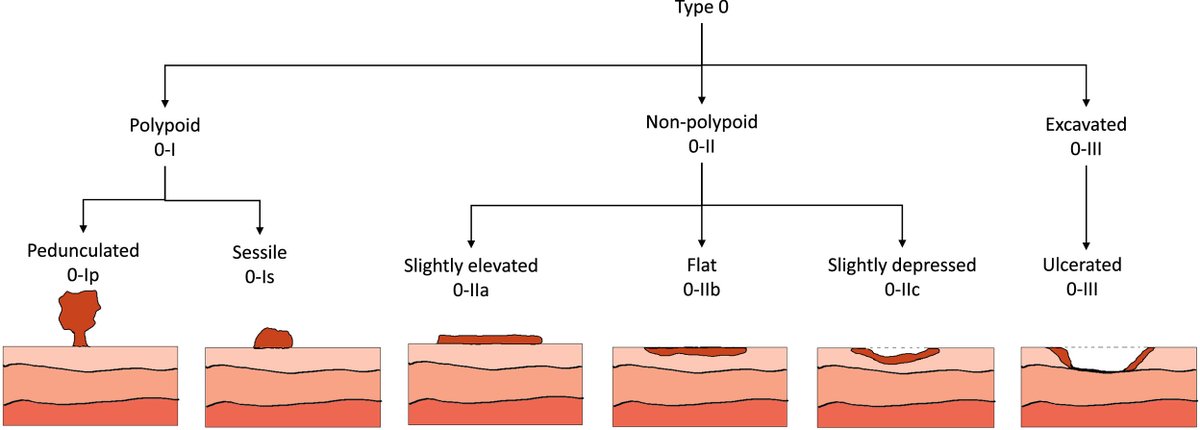 AGA_TIGE's tweet image. #Endoscopicresection can be curative for early #colorectalcancers, is more cost effective than surgery, and is associated with lower morbidity  ow.ly/b8wu50NmZPC @VinayChandraMD @EHolzwanger @AbiMansourMD @BilalMohammadMD