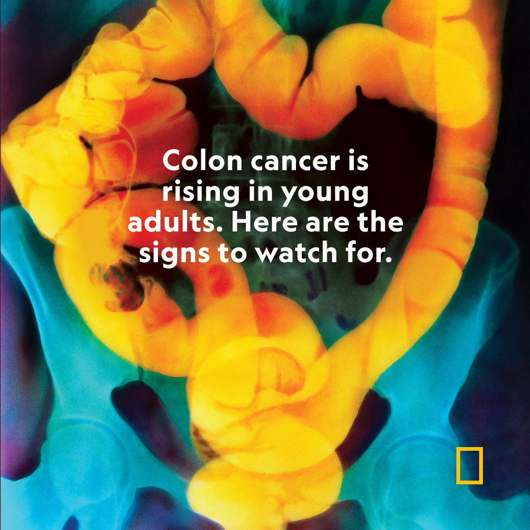 NatGeo's tweet photo. Genetics, the microbiome, and low screening rates may be factors in the increase, experts say. Here are risk factors for the disease—and the most common symptoms https://t.co/JGhTtIgfgU https://t.co/b2fV92WV9s