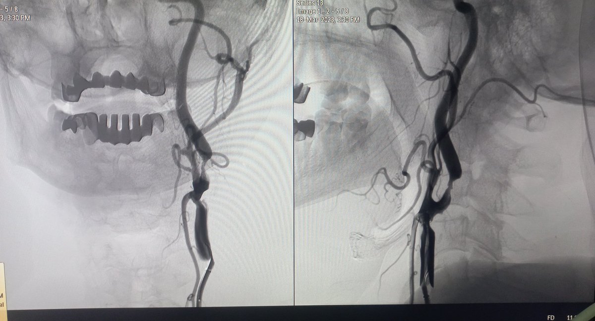documar's tweet image. 56 year old man with history of multiple TIAs. Carotid Angio showed unstable plaque in ICA.
Left ICA stented with casper 5×30 under the able supervision of @aliraza987_raza @Mohamma22774282 and @Rafiull33056172
#cardiovascular #Cardiotwitter