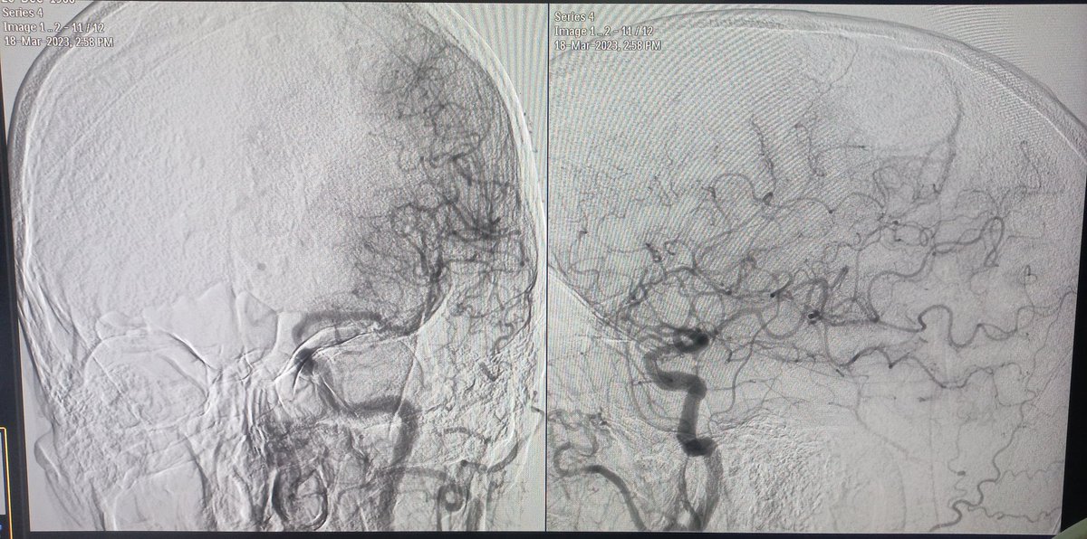 documar's tweet image. 56 year old man with history of multiple TIAs. Carotid Angio showed unstable plaque in ICA.
Left ICA stented with casper 5×30 under the able supervision of @aliraza987_raza @Mohamma22774282 and @Rafiull33056172
#cardiovascular #Cardiotwitter