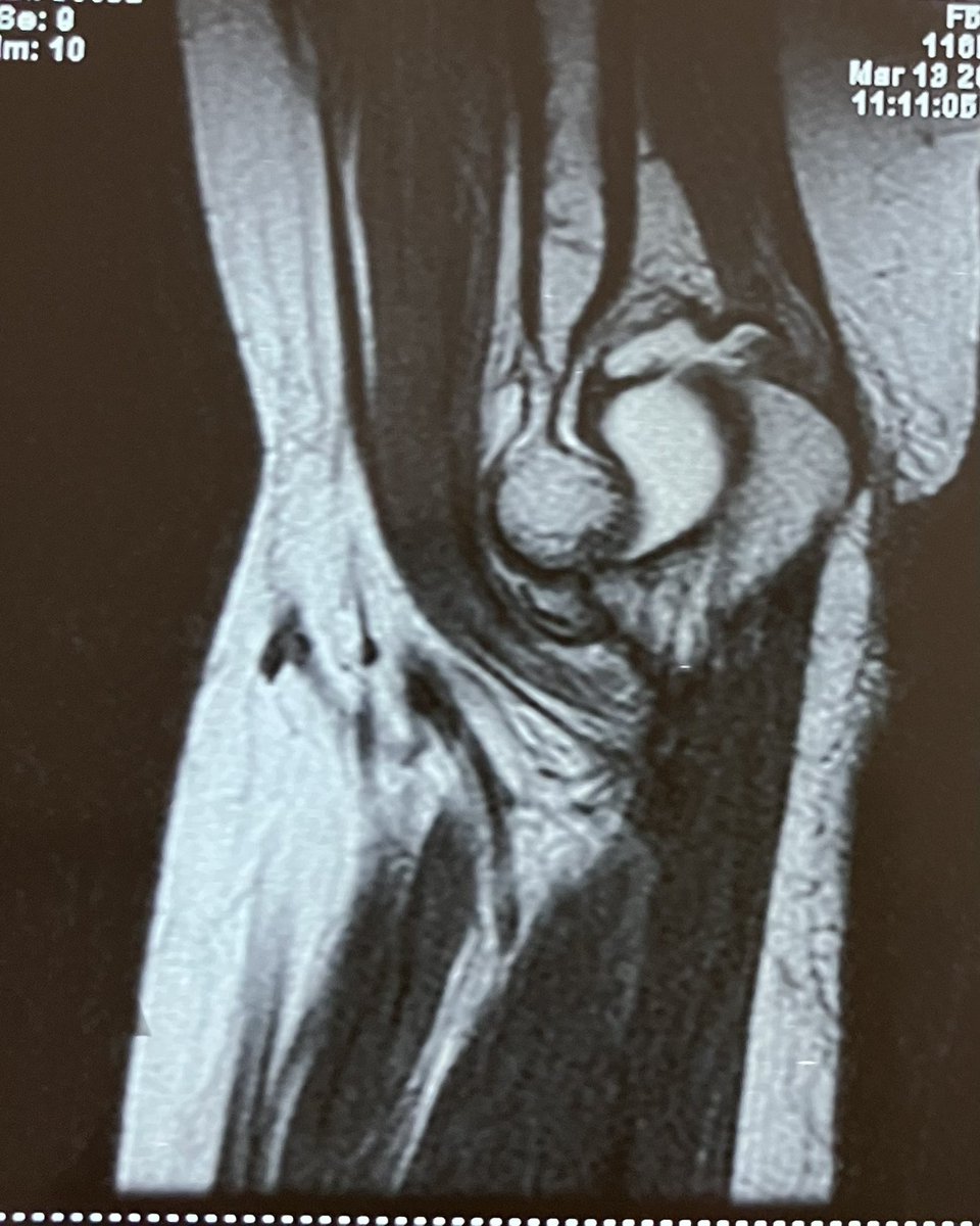 Perched elbow. Posterolateral rotatory instability. One year since trauma. Needs LUCL reconstruction. #handsurgery