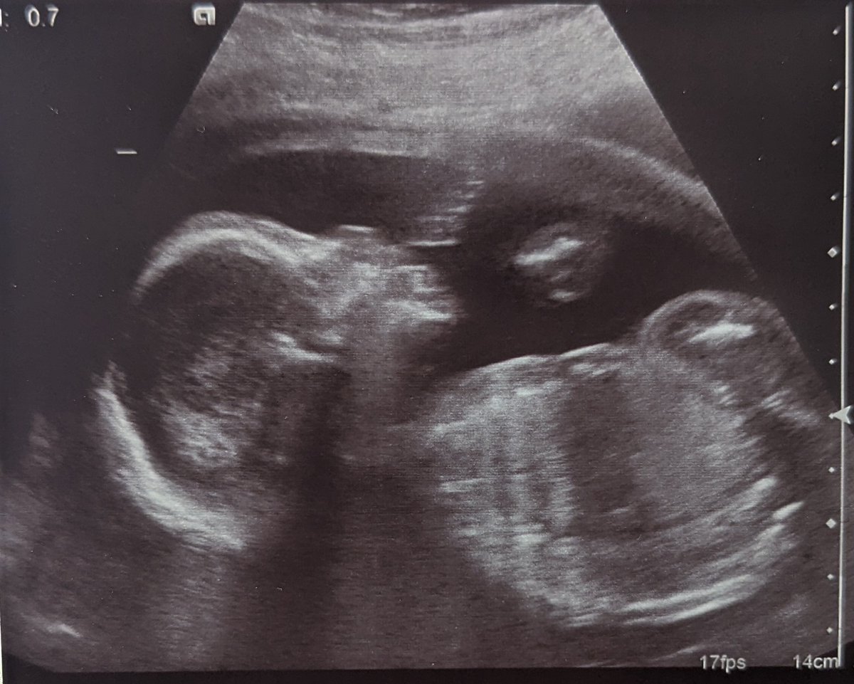 StringaTheory's tweet image. So let&apos;s just say the last week has been a bit insane. A week ago, we moved house, after what has been quite a stressful journey.

A week later, today...

We found out...

WE&apos;RE HAVING A BABY GIRL! 

Arriving August 2023 💓💓

@kieran_housley