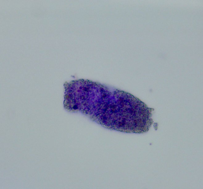 SwethaKanduriMD's tweet photo. Oval fat body and lipid casts in a patient with h/o uncontrolled DM, UPCR:23 grms. Work up in progress. Pending Kidney Biopsy @anaisabelstark @therealleadAPP #MalteseCross #UrineSediment https://t.co/sQLcIx3M1m