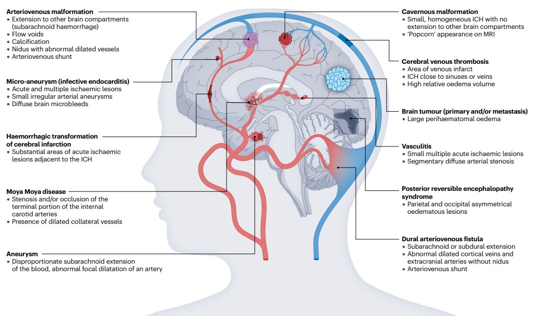 MedinaRiojaMD's tweet photo. Clues for underlying treatable (emphasis on treatable) causes of intracerebral haemorrhage. 🧠🧠
🧠
 🩸
   🏥🩺

🚨🚨

#Neurology #Neurotwitter #ICH

Reference: Nat Rev Dis Primers. 2023 Mar 16;9(1):14. doi: 10.1038/s41572-023-00424-7. https://t.co/WMy4hnGNOM
