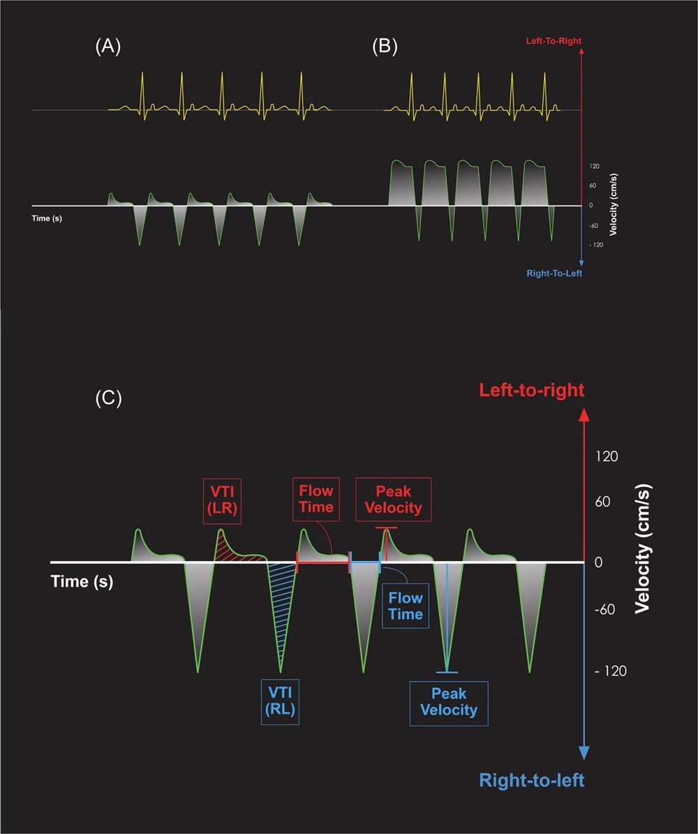 #NeoTwitter Check out our new paper on #CDH by <a href="/BartolomeoBo/">Bartolomeo Bo</a>: Ductus arteriosus flow predicts outcome in neonates with congenital diaphragmatic hernia onlinelibrary.wiley.com/doi/10.1002/pp…  Let‘s move toward a more sophisticated way of looking on #PDA in CDH