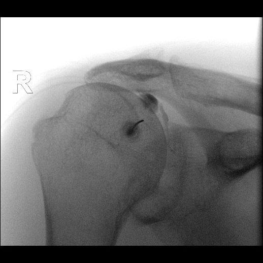atultanejamd's tweet photo. Quiz: What is your diagnosis?

@UTSW_Radiology @UTSW_RadRes @UTSWNews
@BoneVancouver @intskeletal @DrHugue @AChhabraMD @DmcRadiologia

#MedTwitter #radtwitter #radiology #orthopedics #shoulder #arthrogram https://t.co/BqQaW09w8g