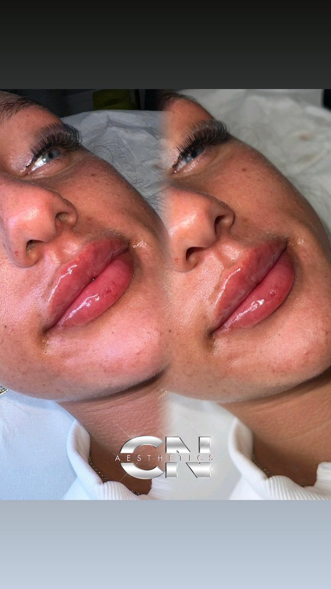 Chloenight_'s tweet photo. Russian Lips 

#cnaesthetics #fyp #lipinjection #dermalfiller https://t.co/R1ZVMQozoB