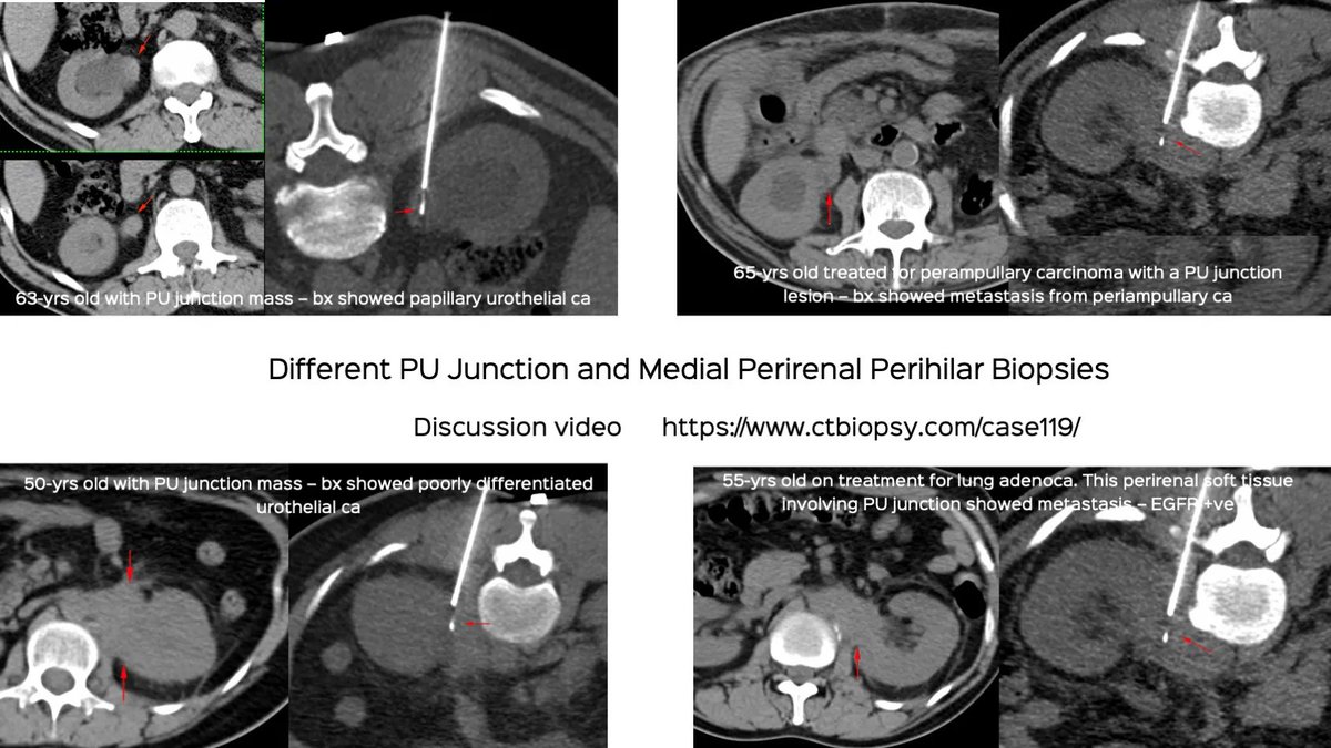 Different PU Junction and Medial Perirenal Perihilar Masses

These are easy to do percutaneously. 

Discussion and video 
ctbiopsy.com/case119/

#ctbiopsy #irrad #pelviuretericjunction #PUJ #urothelialcarcinoma #perirenal