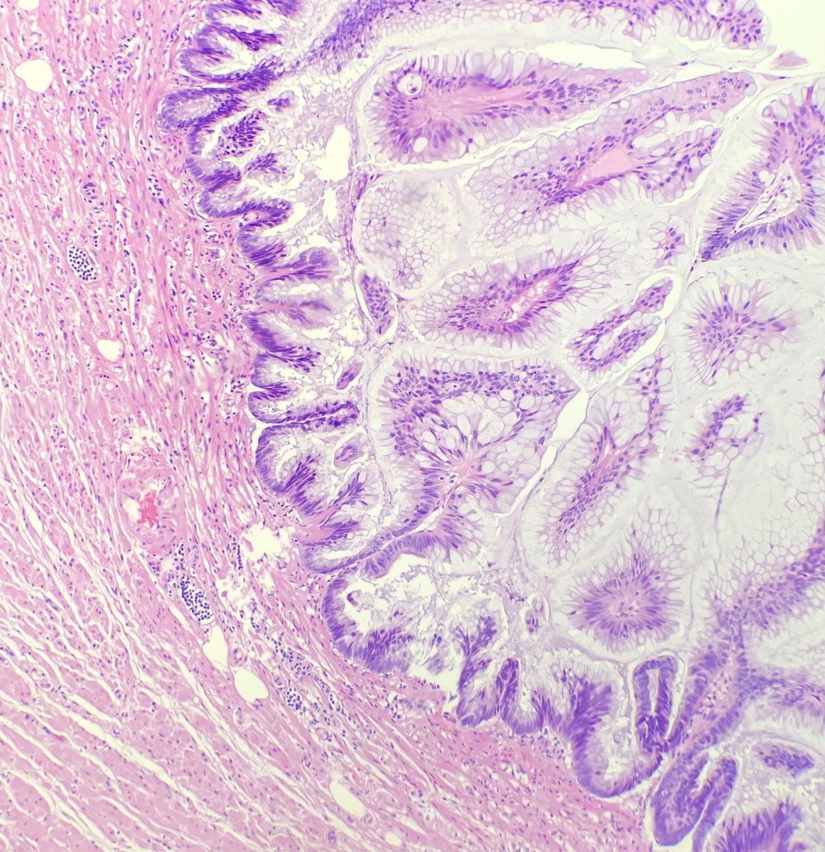 The fun part of residency is getting to everything for the first time! 

I’ve seen LAMNs inside an operating room but to finally see it under a microscope is even better 🤩 #gipath #pathresidency