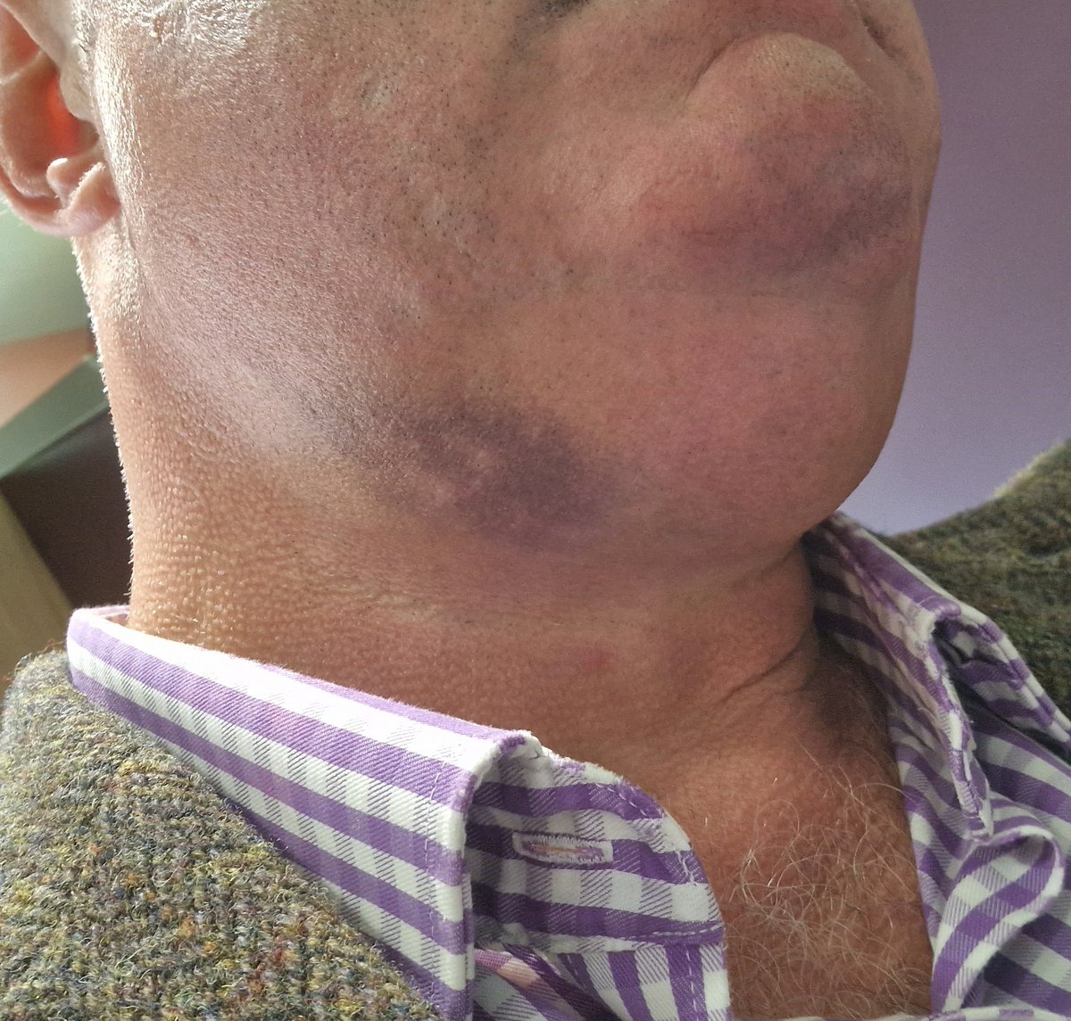 On 22/8/22, I was assaulted by a group of teenagers while walking my dog. Nose &amp; cheekbone broken, cuts, bruises,dislocated jaw.
The case is being heard on Thursday. I've decided to go to court to speak up for the lad who's  charged with the assault.  Physically,  I have