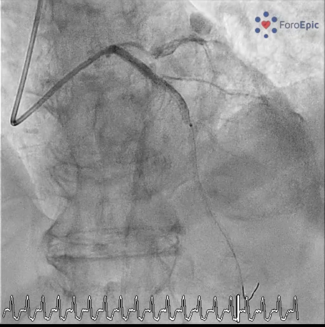 foroepic's tweet image. We already have the solution of the case at foroepic.org #ELCA #OPN #GEC @foroic @AJuradoRoman @pbaglioni @pipecardio  @Felipediezhoyo @Otarrec