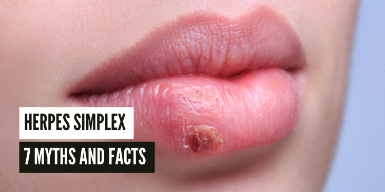 LisaBrown2016's tweet photo. Separate herpes simplex myths from facts with this informative blog post! Learn more about the causes, symptoms, and treatment of this common sexually transmitted infection. #herpes #STI #sexualhealth #mythsandfacts https://t.co/57aJvPmRzt https://t.co/saYZOjV9X5