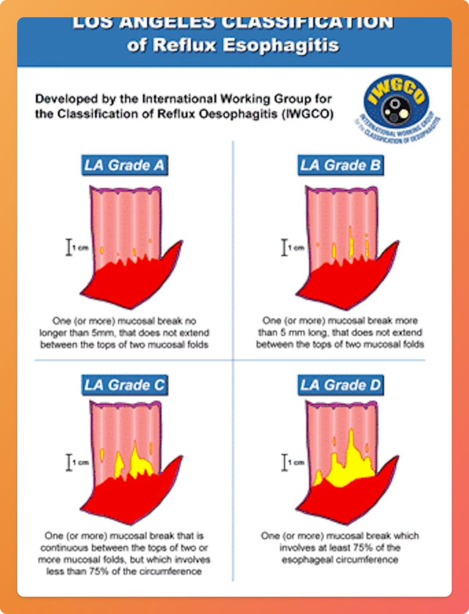 Reflux Esophagitis - Los Angeles Classification