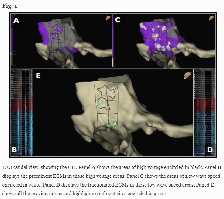 🚨New #OpenAccess Article in <a href="/JICE_EP/">JICE</a>

First Experience of Wave Speed Guided Point-by-Point Cavo-Tricuspid Isthmus Ablation for Typical Atrial Flutter

by <a href="/ermengolvalles/">Ermengol Valles Gras</a> J Jiménez, Benjamin Casteigt &amp; Colleagues

🧐📖link.springer.com/article/10.100…

#EPeeps
