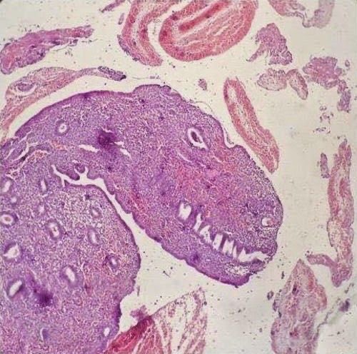 DoctorBhavsar's tweet image. This pathology slide went extinct