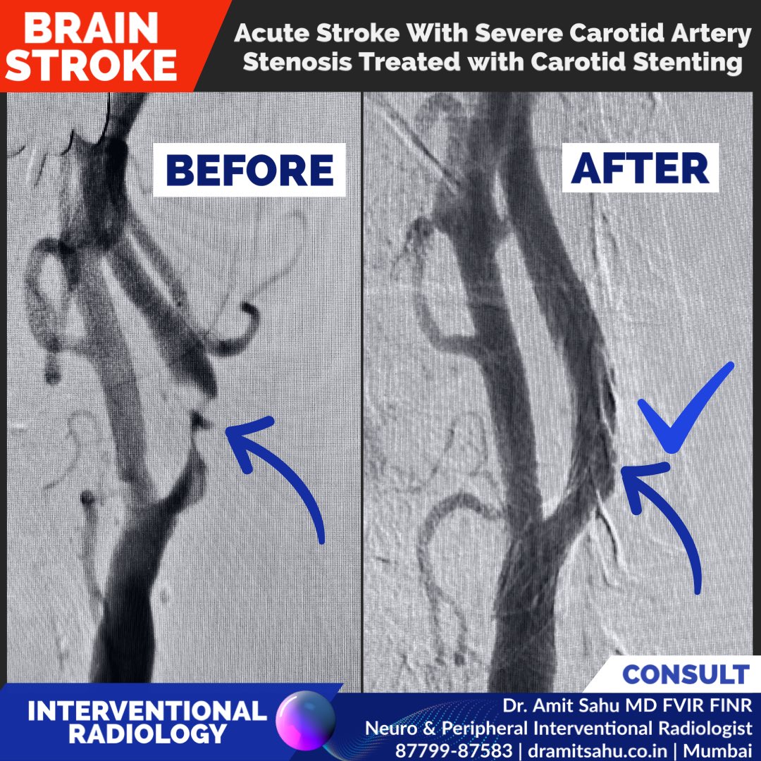 Dr. Amit Sahu MD FVIR FINR tweet media