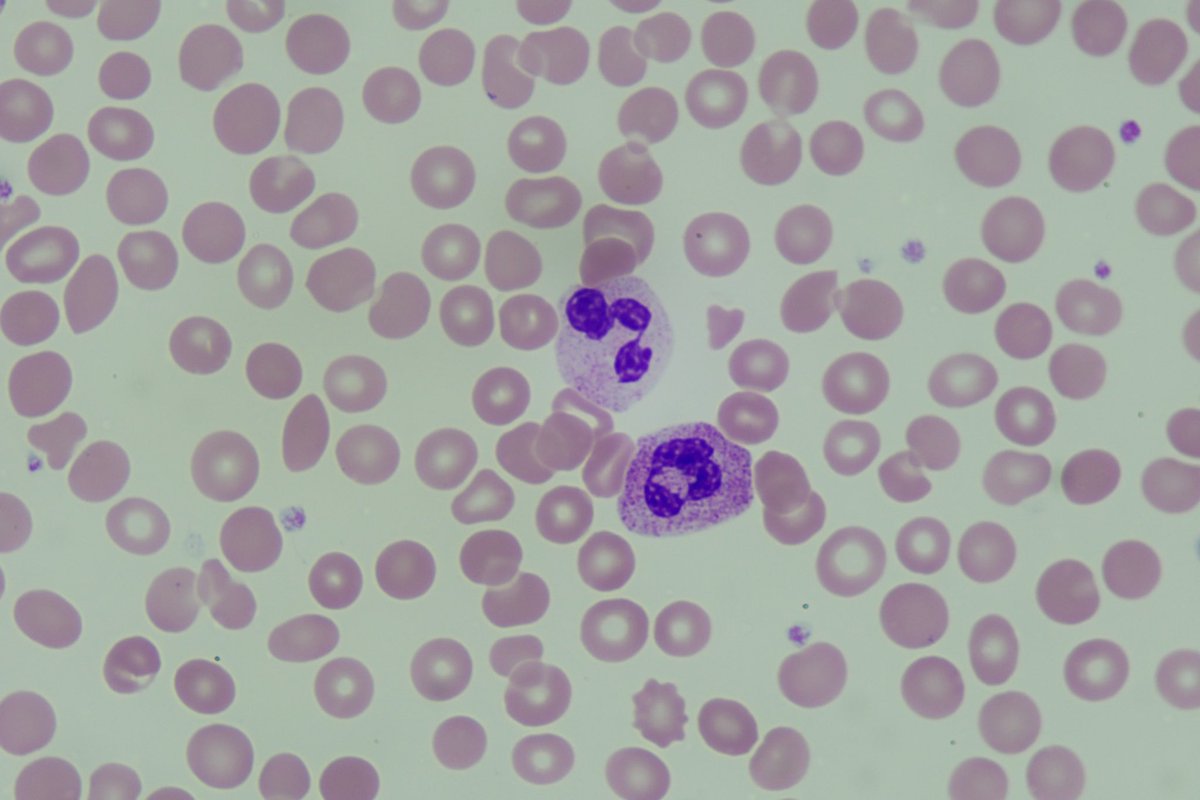 diff_discussion's tweet image. Our next video focuses on the effects of G-CSF on the peripheral blood smear youtu.be/8tIHKxoTuNI