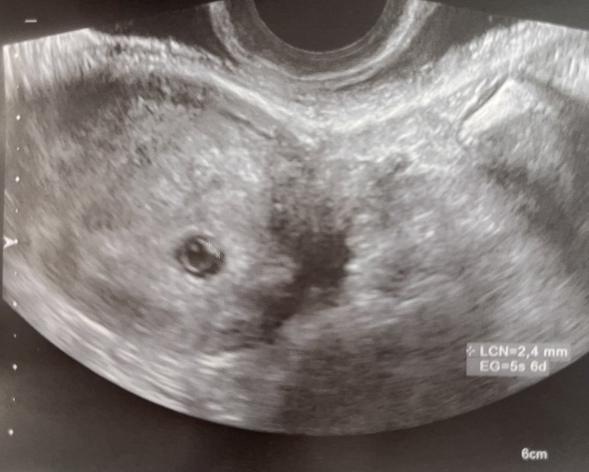 #infertilpreñis #infertilpandy acabo de salir de mi 1 eco x ss. Médico seco seco. Estoy de 5smn y 6 dias. Se veia parpadear, dijo k era el latido. Pero ni me lo dejo escuchar. ¡Que poca empatía!pero lo menos dijo k estaba todo bien.esto es lo k vi