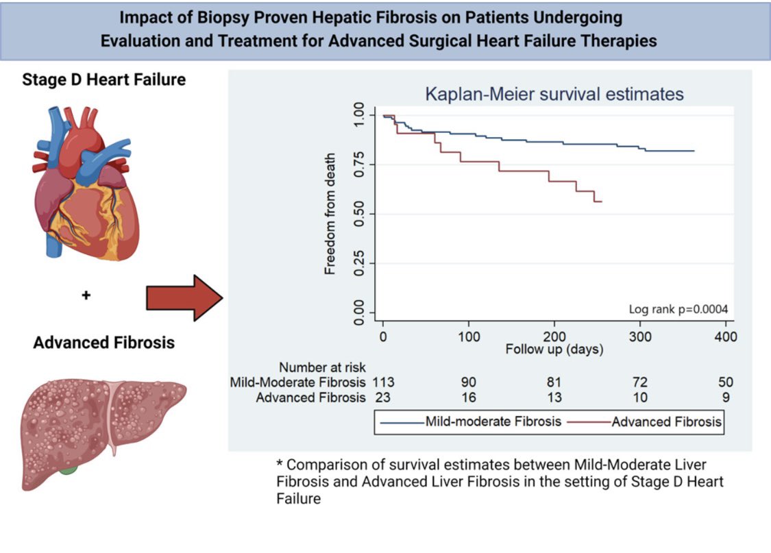Largest study so far from our KU data base in Advanced heart failure population with liver fibrosis needing advanced therapies published in The American Journal of Cardiology.  protect-us.mimecast.com/s/0K6uCqxrMmu8…                     Thanks to all my co-authors and senior authors.
