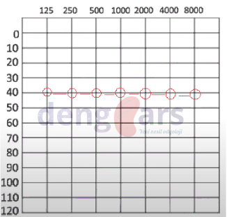 dengears_'s tweet photo. Flat konfigürasyon işitme kaybında, yüksek ve alçak frekanslarda ki eşikler birbirine yakındır.

#hearing #audiology #audiogram #hearingloss #configuration #odyoloji #odyogram #işitmekaybı https://t.co/Kj8uSdIP1t