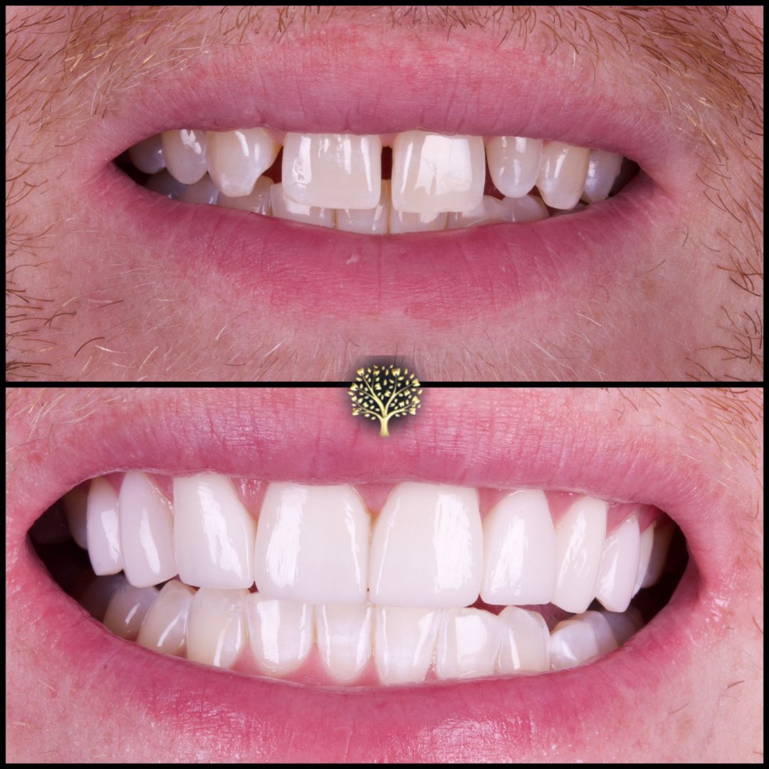 This patient came to visit us as he wanted to do something about the spaces he had in his smile. He had a missing tooth on one side, and a smaller tooth on the other. 

In this smile-makeover: 
✨ 5 Porcelain Veneers
✨ 4 Composite Veneers 

#compositeveneers #porcelainveneers