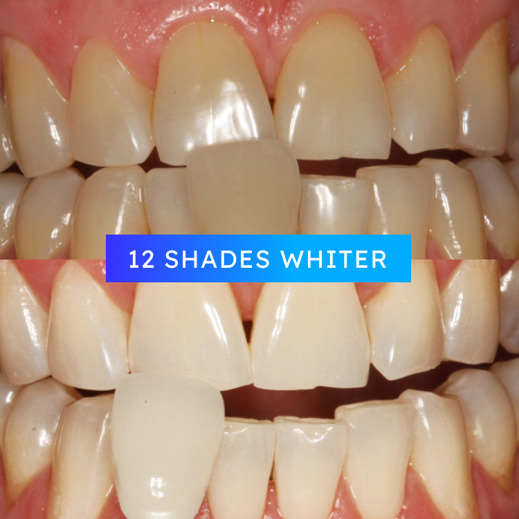 GLOSciencePro's tweet photo. With just 16 minutes of total treatment time, no impressions or lab fees, and no sensitivity, GLO Science Pro delivers the unparalleled results your practice and patients are looking for.
info@gloscience.com | 855-745-6776
#GLOSciencePro #DSO #TeethWhitening #CosmeticDentistry https://t.co/IJBEqoXCCc