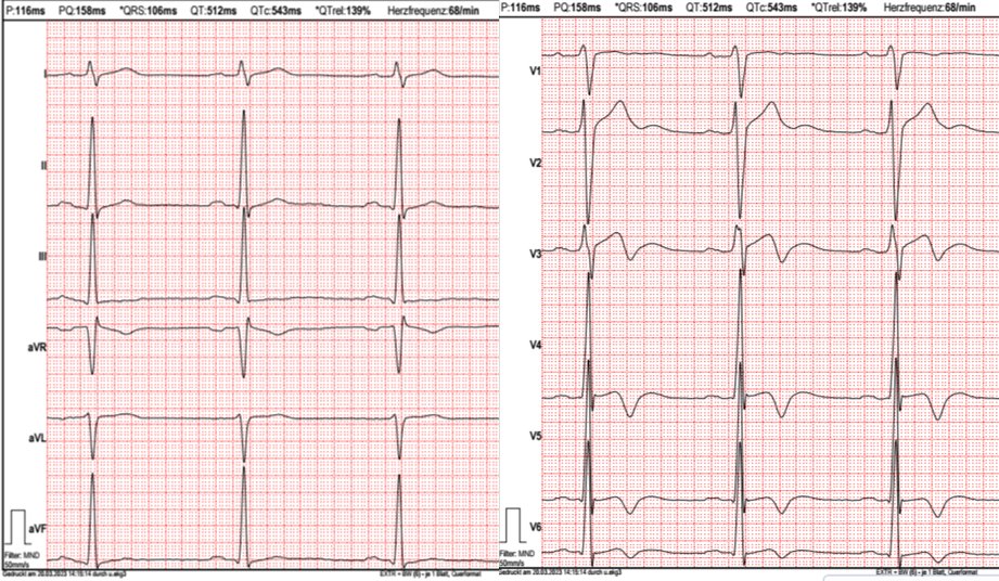 doc_cardio's tweet photo. 22-yr old young man, healthy&asymptomatic presents for routine check-up before starting with the fire brigade. What do you suspect? https://t.co/jJENhccCqp