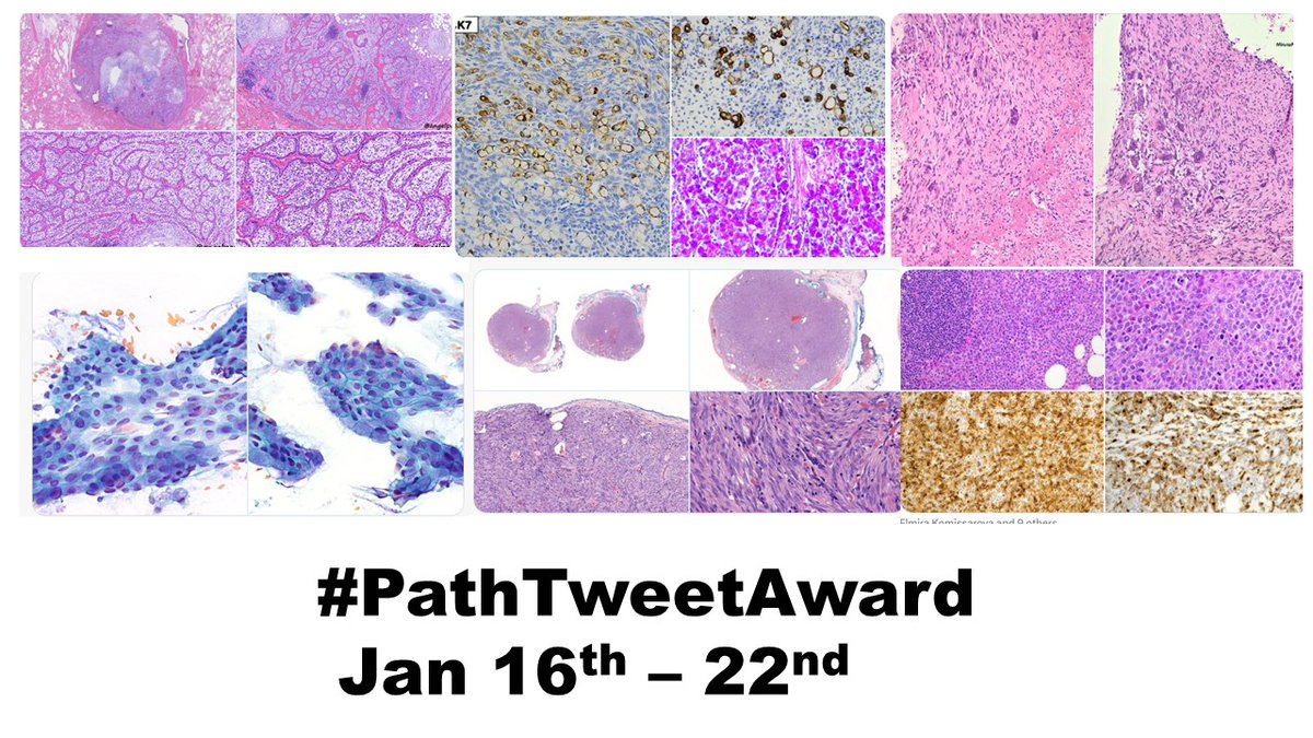 Vijay Shankar S (@vijaypatho) on Twitter photo “#PathTweetAward Jan16-22” - <a href="/VijayPatho/">Vijay Shankar S</a> “x.com/VijayPatho/tim…”
<a href="/PoojaSMD/">Pooja Srivastava</a> <a href="/DrGeeONE/">Olaleke Folaranmi</a>
<a href="/Baskotacytopath/">Swikrity U Baskota,MD, FCAP,FASCP</a> <a href="/HermelinMD/">Daniela Hermelin, MD</a> <a href="/GIJamesMD/">GI James</a>
<a href="/seyma_buyucek/">Şeyma Büyücek</a> <a href="/adi_agnihotri/">Aditya Agnihotri 🇮🇳</a>
<a href="/ariella8/">Celina Stayerman MD</a> <a href="/archibhat3/">Archana bhat</a>
<a href="/cebulka26/">Anna (Ania) B. Owczarczyk, MD PhD FASCP</a> <a href="/LakshmiKoulmane/">Sindhura Lakshmi</a>
@pembeoltulu@Path_Matt
<a href="/VHNguyenMD/">Van-Hung Nguyen MD 🇺🇦🌻</a> <a href="/rdpatho/">rajEndiran</a> “#PathTweetAward Jan16-22” - <a href="/VijayPatho/">Vijay Shankar S</a> “x.com/VijayPatho/tim…”
<a href="/PoojaSMD/">Pooja Srivastava</a> <a href="/DrGeeONE/">Olaleke Folaranmi</a>
<a href="/Baskotacytopath/">Swikrity U Baskota,MD, FCAP,FASCP</a> <a href="/HermelinMD/">Daniela Hermelin, MD</a> <a href="/GIJamesMD/">GI James</a>
<a href="/seyma_buyucek/">Şeyma Büyücek</a> <a href="/adi_agnihotri/">Aditya Agnihotri 🇮🇳</a>
<a href="/ariella8/">Celina Stayerman MD</a> <a href="/archibhat3/">Archana bhat</a>
<a href="/cebulka26/">Anna (Ania) B. Owczarczyk, MD PhD FASCP</a> <a href="/LakshmiKoulmane/">Sindhura Lakshmi</a>
@pembeoltulu@Path_Matt
<a href="/VHNguyenMD/">Van-Hung Nguyen MD 🇺🇦🌻</a> <a href="/rdpatho/">rajEndiran</a>
