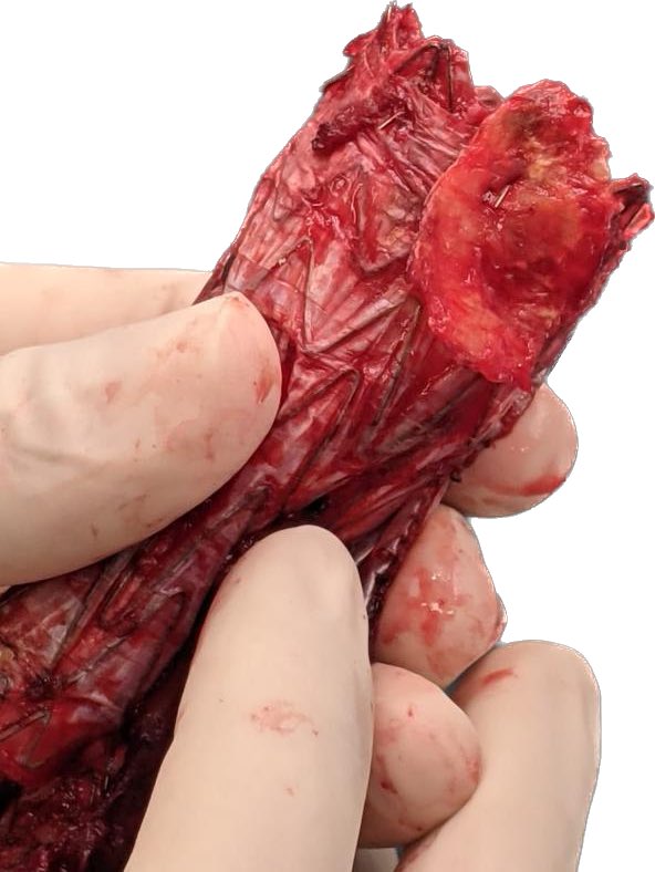 Infrarrenal fixation: it seems a tromboendarterectomy ! #aortaed.