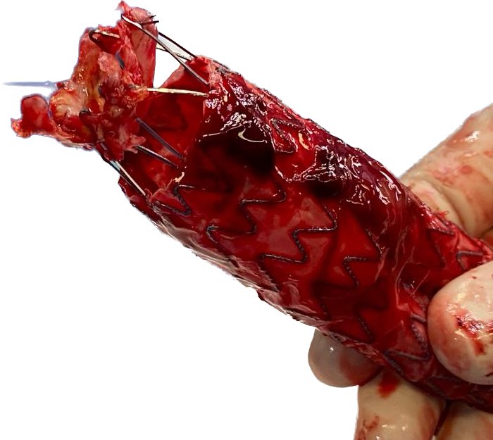 Suprarrenal fixation! It seems a thromboendarterectomy #aortaed