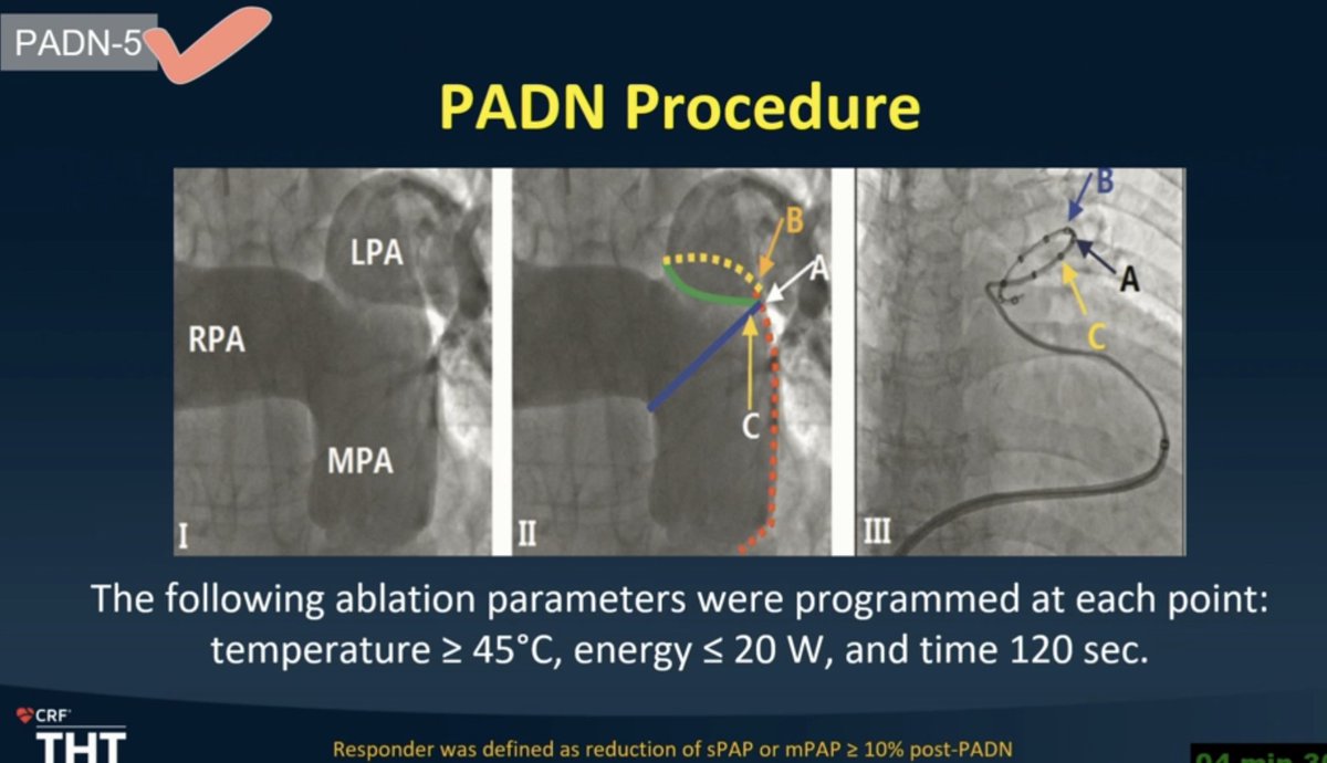 HanCardiomd's tweet photo. The 3-year follow-up of #PADN-5 trial demonstrates the long-term benefits of #PAD for patients with #CpcPH
#THT2023 @crfheart @TCTMD @TCTConference @DrNasrien @RyanTedfordMD @docbhardwaj @WilfriedMullens @FH_Verbrugge @yaleHFdoc @BartoszHudzik https://t.co/ZV6qgVNx1Y