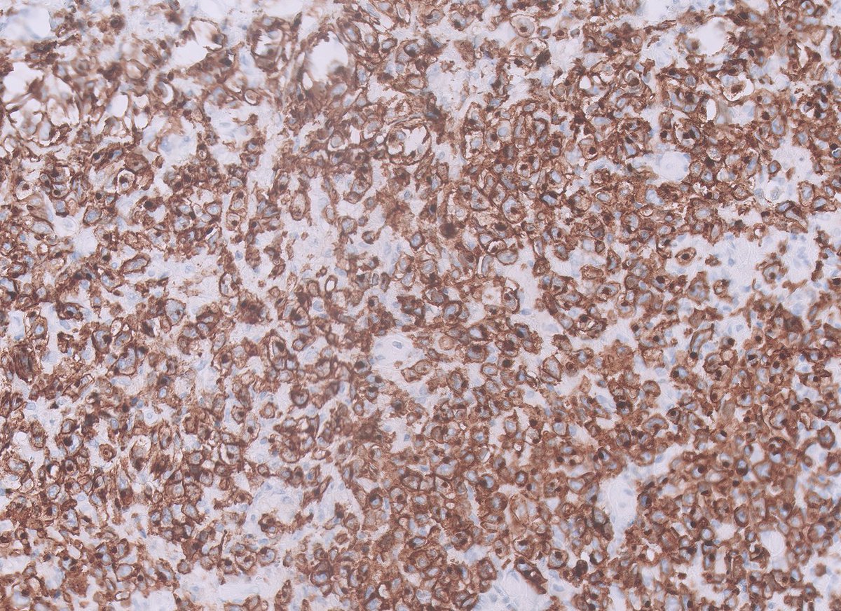 Coming back after an amazing #uscap2023 

Breast capsule from an adult woman

Guess the stain and the diagnosis (piece of cake)

#hemepath #breastpath #PathTwitter