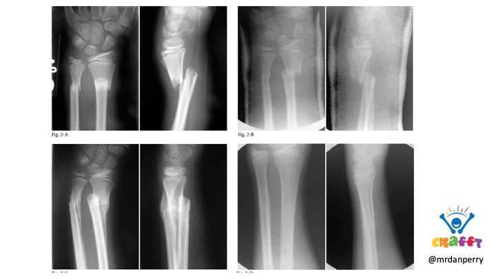Management of buckle fractures has progressed from Plaster of Paris (POP) & follow up to essentially no treatment or follow-up. Convincing clinicians to treat an off-ended radial # with just a POP is going to be an order of magnitude greater implementation challenge #PEM23