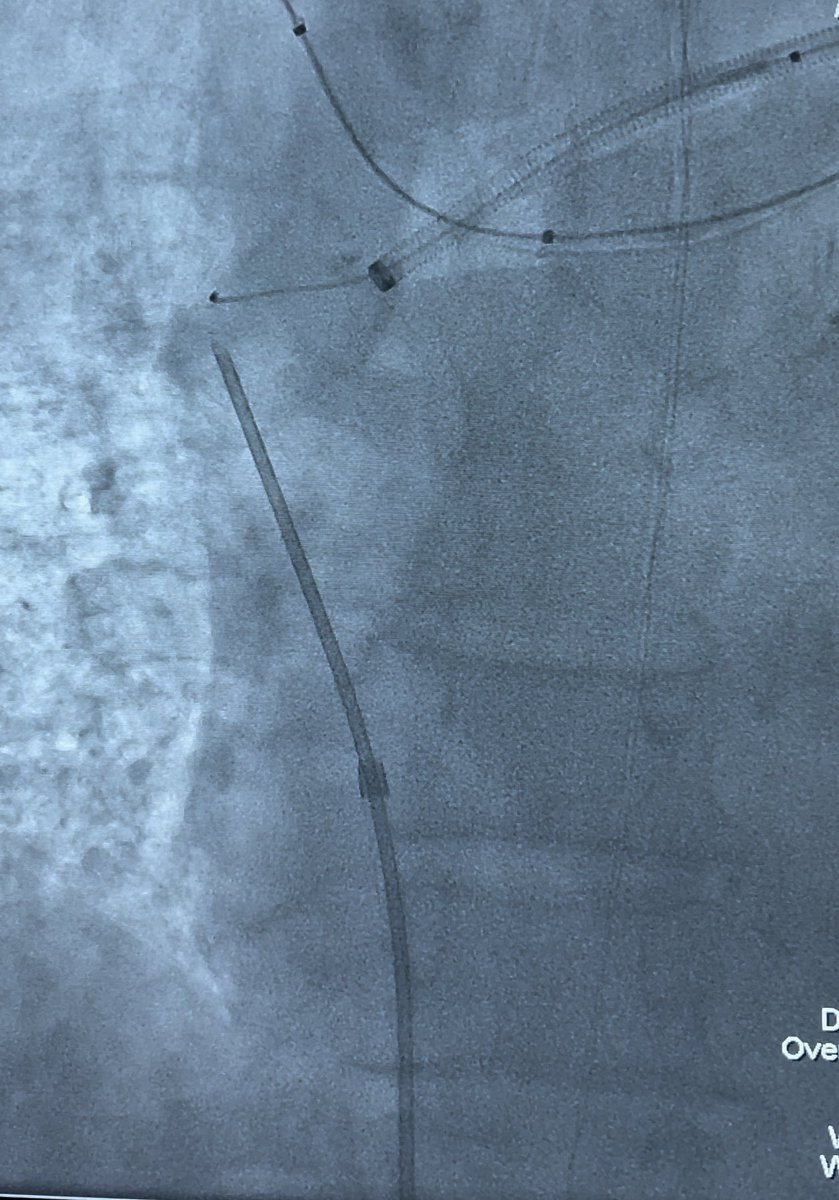 othman_Irad's tweet photo. #Tips_needle utilized for #sharp_Recanalization through right atrium under biplane fluoroscopic guidance. #VBX stent deployed, flow restored. https://t.co/1ONGGF7UaE