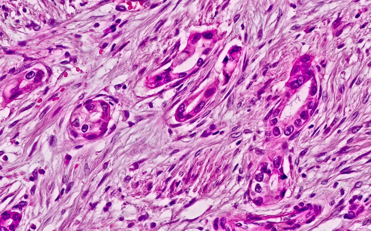 Cervical adenocarcinoma, gastric type (HPV-independent) #PathTwitter #gynpath