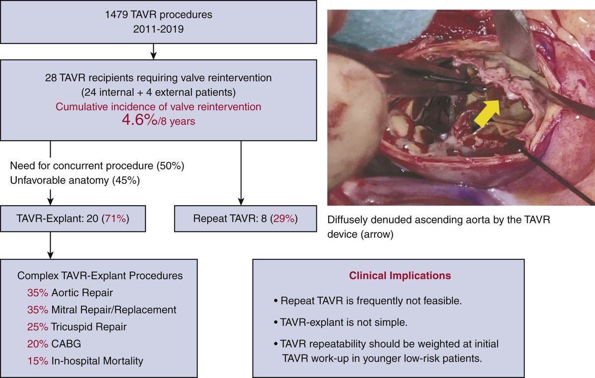 Aortic valve reintervention after transcatheter aortic valve replacement. Read the full #JTCVS article by <a href="/ShinFukuharaMD/">Shinichi Fukuhara, MD</a>, Deeb, et al: doi.org/10.1016/j.jtcv… 

<a href="/AATSHQ/">AATS</a> <a href="/tssmn/">CTSurgSocMedNetwork</a> <a href="/BoYangMD/">Bo Yang</a> <a href="/KarenMKimMD1/">Karen M Kim, MD</a> <a href="/GAilawadiMD/">Gorav Ailawadi</a> #aorticvalve