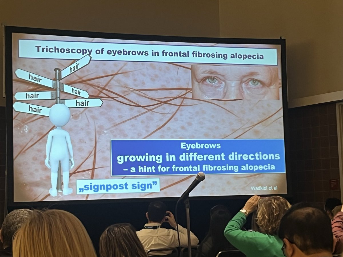 Wonderful pearl from Prof. Lidia Rudnicka: the signpost sign. Eyebrows may grow in different directions in frontal fibrosing alopecia. #AAD2023challenge #AAD2023 @AADmember
