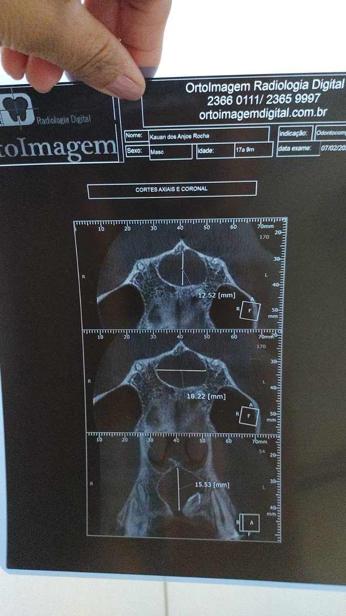 trystanmverine's tweet photo. Boa noite gente
Hoje venho aqui fazer um pedido, eu tenho um irmão de 17 anos chamado Kauan, e recentemente ele fez exames no dentista e foi constatado que ele tem um cisto no dente que está corroendo as raizes dos dentes da frente dele e cada dia que passa corre mais risco de + https://t.co/amFN2uNsY1