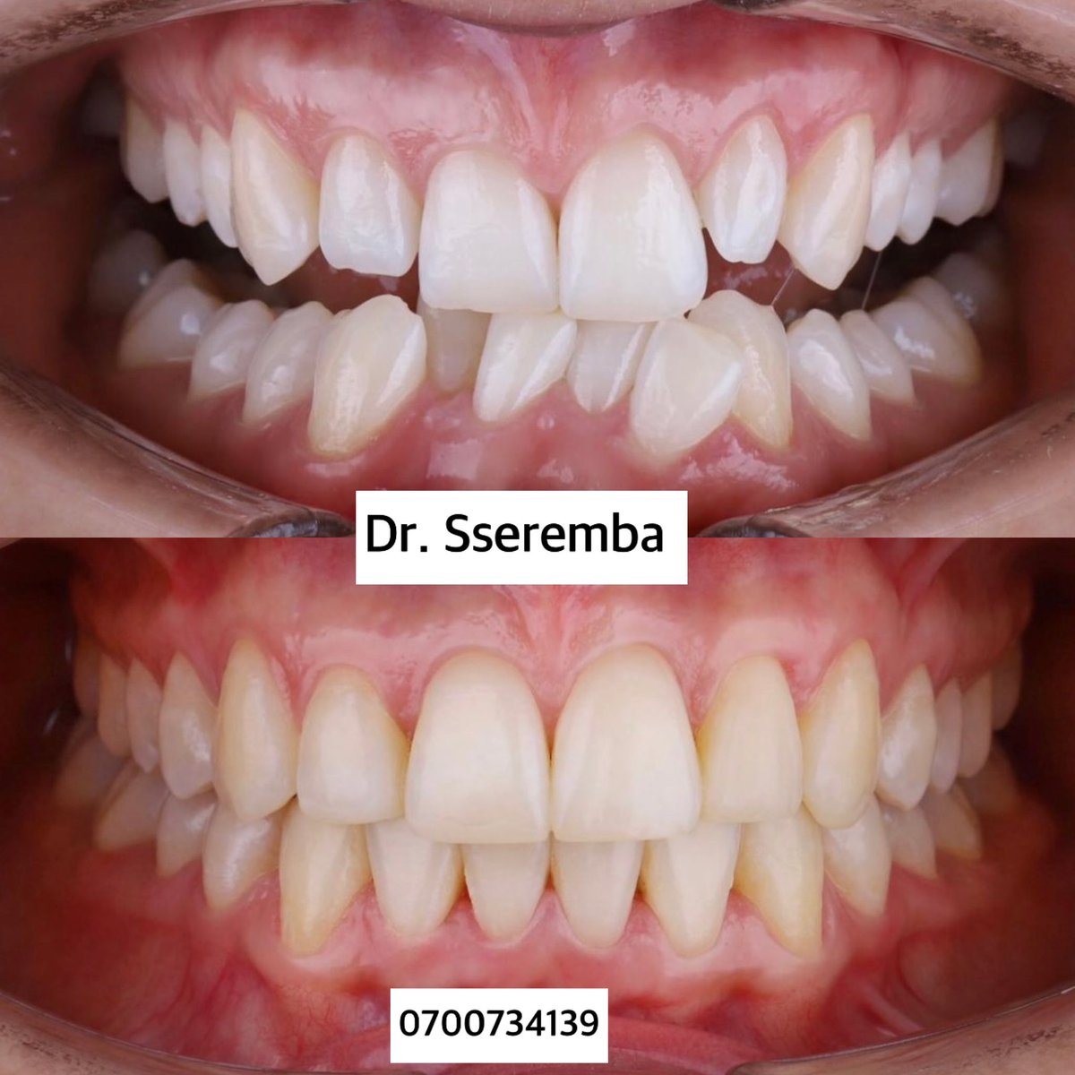 SserembaDental's tweet image. Be proud of your smile today 😊 or have a visit to your dentist to fix it. Do you love it 🥰 
#Braces 
#TeethAlignment 
#DrSseremba 
#AskTheDentalSurgeon