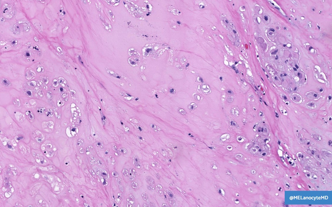 MELanocyteMD's tweet image. &quot;Chordoid/Chondroid&quot;
- Chondroid area in an otherwise conventional chordoma
#bstpath #pathart