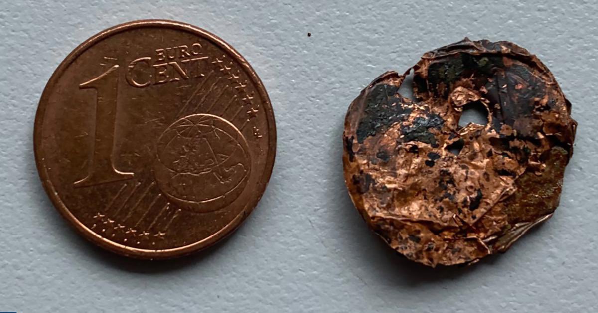 OGdukeneurosurg's tweet photo. This is what a coin looks like after it sat in a man’s lung/ bronchial tree for one year. https://t.co/7oK8L34ACZ