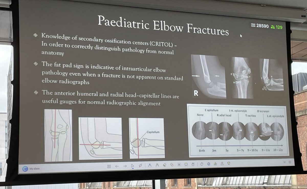/3 
<a href="/FayChall86/">Fay Challender</a> walks us through common pitfalls in Paediatric Radiology 🤕🩻