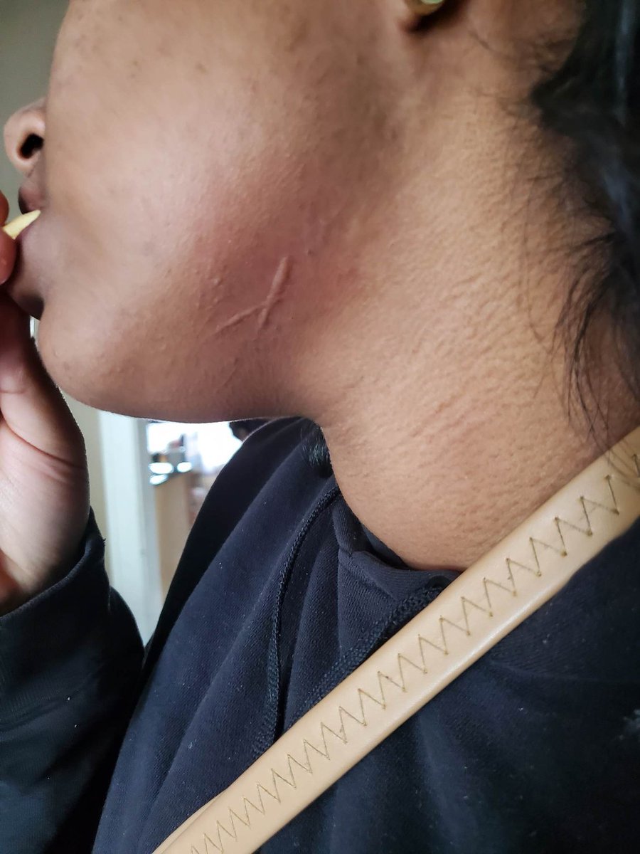Rissajohns's tweet photo. Meet Nizana a 15yrs old in #CambellOhio she suffers from strange hives after the #ohiotrainderailment #EastPalestine  #ohio
Campbell is 20 miles away..
GET THESE RESIDENTS HELP! 
@JDVance1 @Selene406 @CryptoChloeee @WTPACUnited @Cjcoop22 @itsmekc @ThaWoodChipper https://t.co/VIgEnPuGha