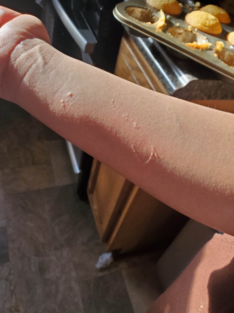 Rissajohns's tweet photo. Meet Nizana a 15yrs old in #CambellOhio she suffers from strange hives after the #ohiotrainderailment #EastPalestine  #ohio
Campbell is 20 miles away..
GET THESE RESIDENTS HELP! 
@JDVance1 @Selene406 @CryptoChloeee @WTPACUnited @Cjcoop22 @itsmekc @ThaWoodChipper https://t.co/VIgEnPuGha